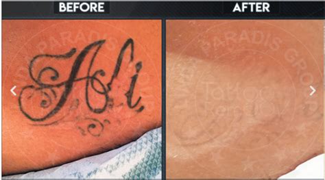 Effective Magnetic Tattoo Removal Techniques: Say Goodbye to Inks!